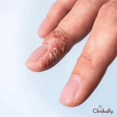Eczema Flare-ups: Treatment