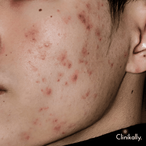 The Impact of Acne Severity on Scarring