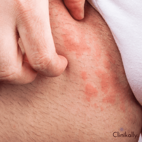 Eczema Flare-ups: Home Remedies