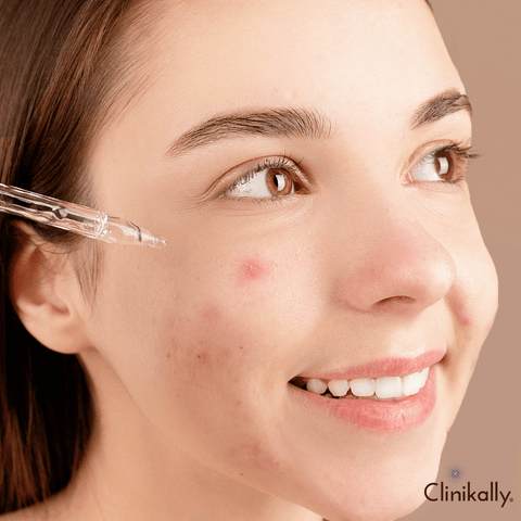 Topical Treatments to Fade Acne Marks