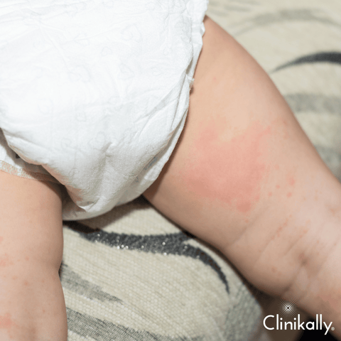 What is diaper rash?