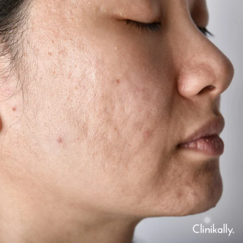 Treating Pigmented Scars