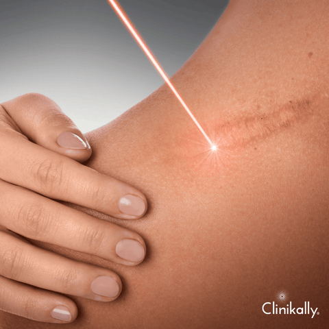Chemical Peels and Laser Therapy