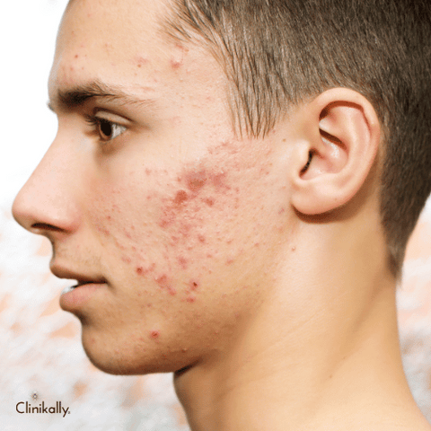 Teenage acne vs Adult acne