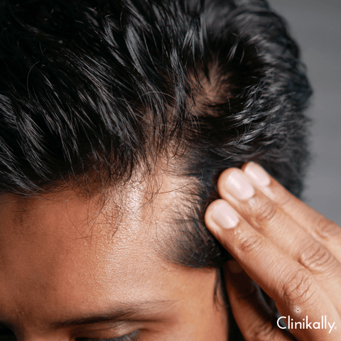 Quick facts about hair loss