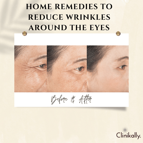 Home remedies to reduce wrinkles around the eyes