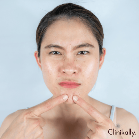 Treatments for oily skin type