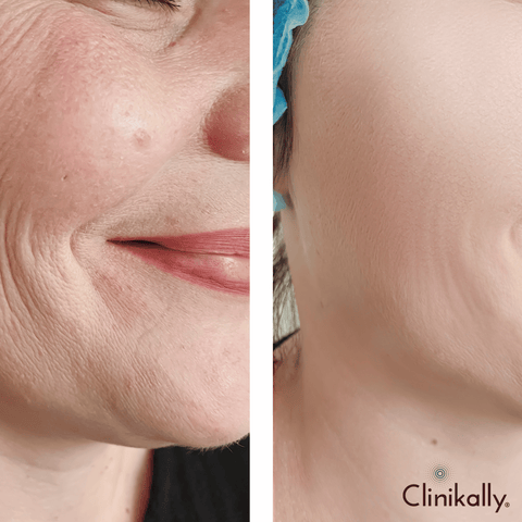 Fine lines and wrinkles treatment