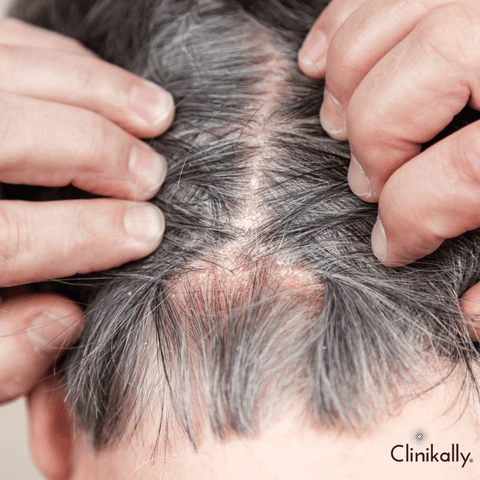 Differentiating Alopecia Areata from other hair loss conditions