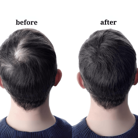 The history and evolution of Minoxidil in hair treatment