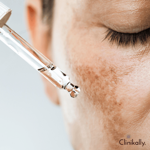 Alpha Arbutin for Melasma and Uneven Skin Tone