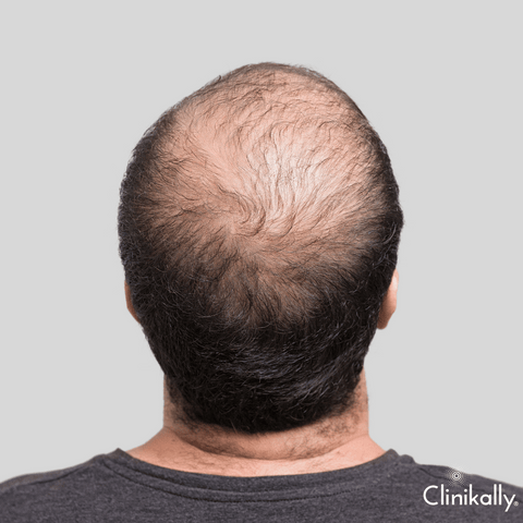 Types of Alopecia Areata