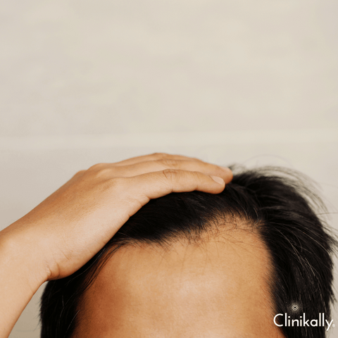 Classifying different forms of Alopecia Areata