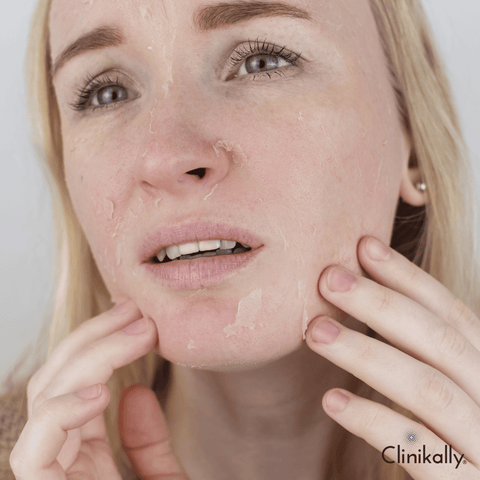 Common skin concerns in winter