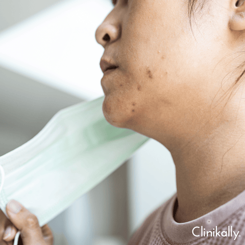 Useful skincare tips if you wear face masks