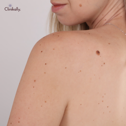 Skin Tags and Their Causes