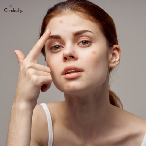  Could Diet Affect Acne? ·