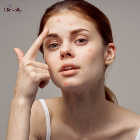 glycolic acid acne treatment 