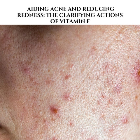 Aiding Acne and Reducing Redness: The Clarifying Actions of Vitamin F