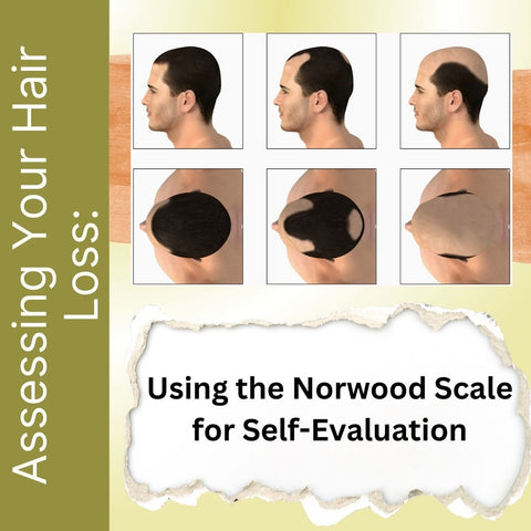 Assessing Your Hair Loss: Using the Norwood Scale for Self-Evaluation