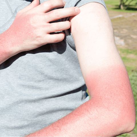 Sunburn Vs. Sun Poisoning: An Overview of the Differences and Symptoms