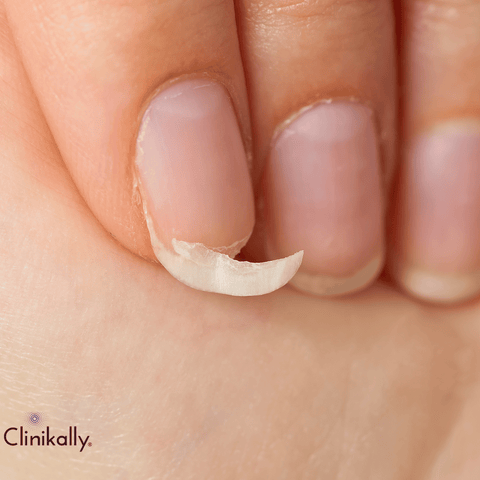 What Do Nail Problems Mean for Your Health?