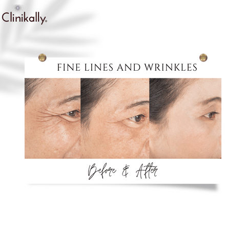 Diminishing Fine Lines and Wrinkles