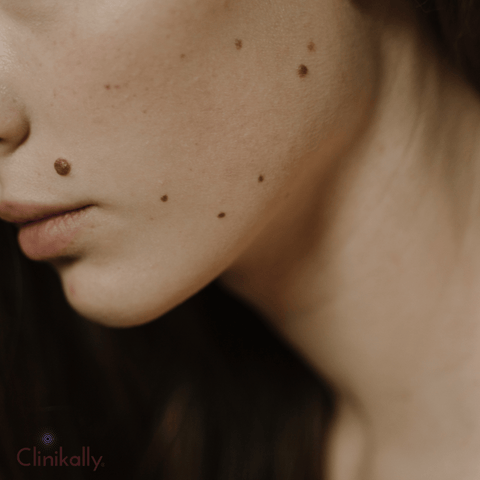 Defining Beauty Marks and Moles
