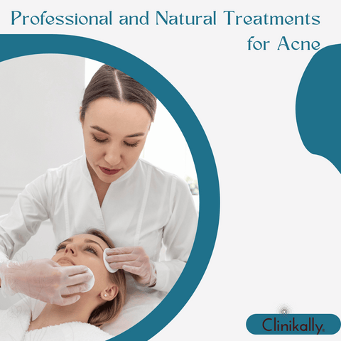 Professional and Natural Treatments for Acne