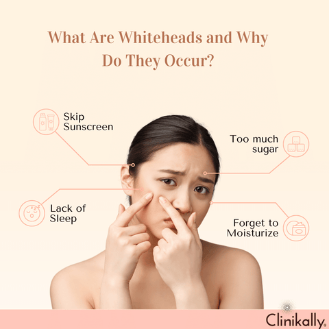 What Are Whiteheads and Why Do They Occur?