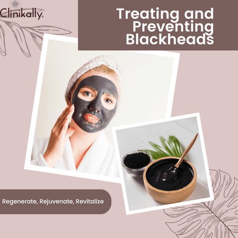 Treating and Preventing Blackheads