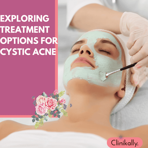 Exploring Treatment Options for Cystic Acne