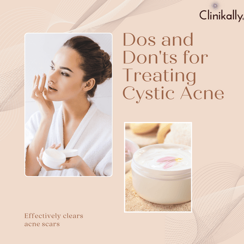 Dos and Don'ts for Treating Cystic Acne