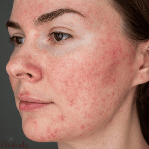 What Is Rosacea and Who Is at Risk?