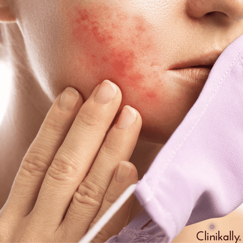 Recognizing the Warning Signs of Rosacea
