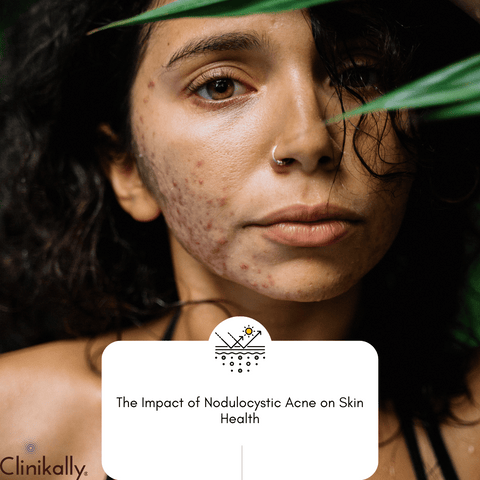 The Impact of Nodulocystic Acne on Skin Health