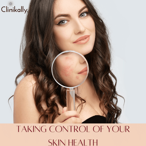 Nodulocystic Acne: Taking Control of Your Skin Health