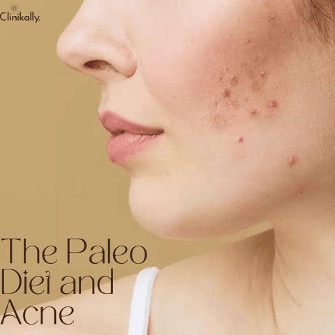 The Paleo Diet and Acne: A New Approach to Skin Health