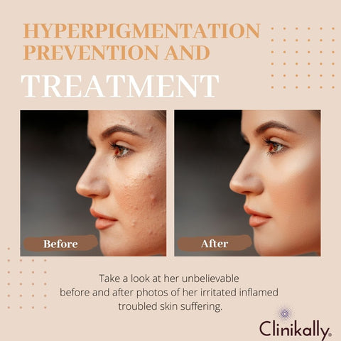 Hyperpigmentation Prevention and Treatment