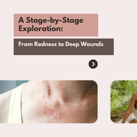 A Stage-by-Stage Exploration: From Redness to Deep Wounds
