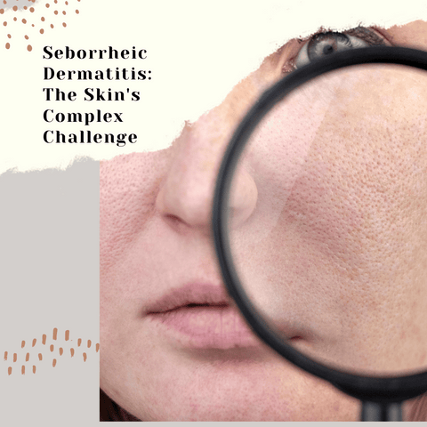 Seborrheic Dermatitis: The Skin's Complex Challenge