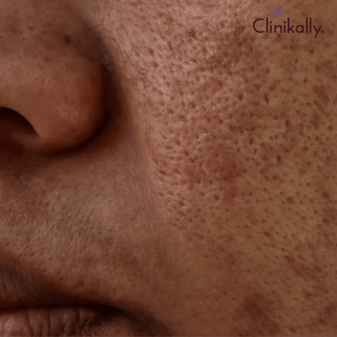 Melasma problem