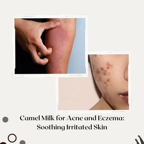 Camel Milk for Acne and Eczema: Soothing Irritated Skin