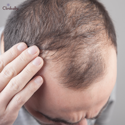 Topical Minoxidil for Hair Loss: Benefits, Side Effects, & How to Use 