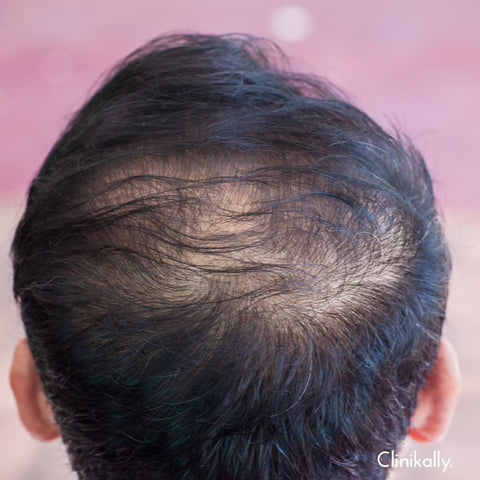 Causes of male pattern baldness