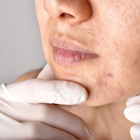 Clinical Guidelines and Expert Recommendations for Navigating Oral Antibiotic Therapy in Acne Rosacea and Pigmentation