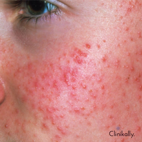 Comparative Analysis of Oral Antibiotics VS Topical Treatments in the Management of Acne Rosacea and Pigmentation