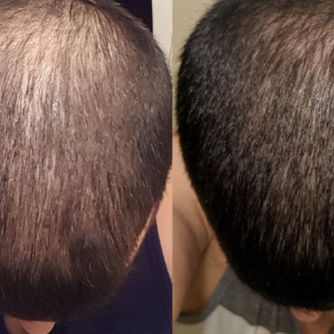 Comparing topical finasteride with oral finasteride for treating hair loss