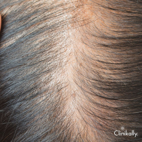 Early signs of thinning hair