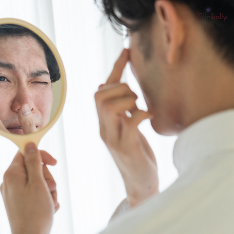 Acne Vulgaris: Causes, Treatment & Home Remedies 